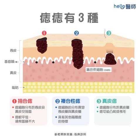 痣為什麼會長毛|痣變大、痣多或長毛會變皮膚癌？認識痣的形成與原因